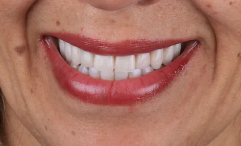 Depois - Prótese Protocolo